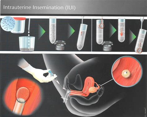 insemination porn|Insemination